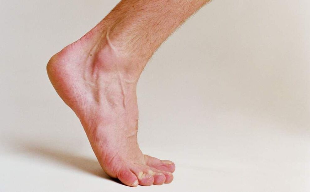 symptômes du pied d'athlète