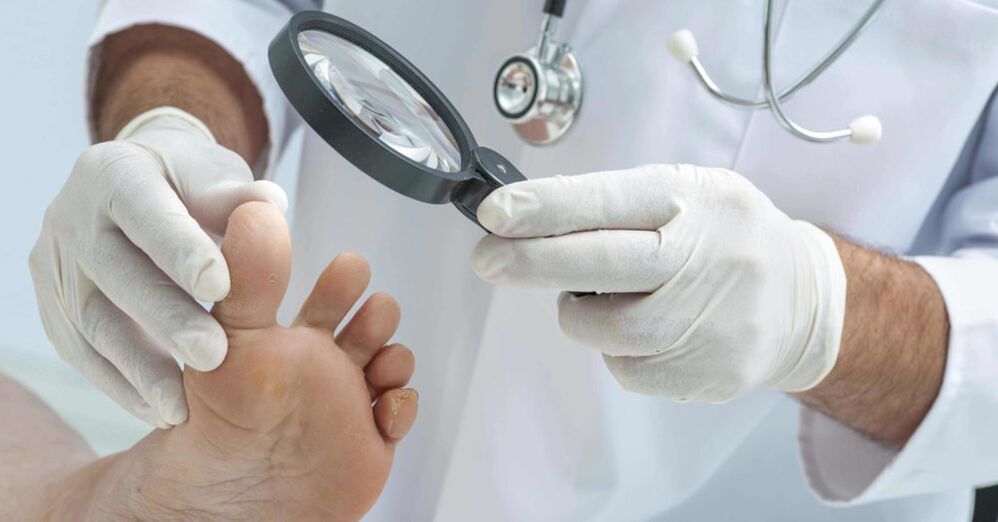 médecin examine les pieds avec des champignons