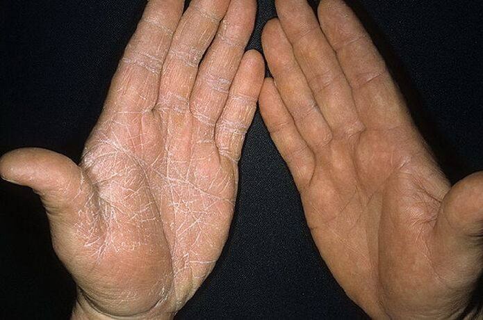 Symptômes d'un champignon sur la peau des mains