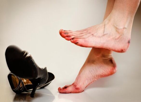 Le développement de mycose des ongles des pieds peut être causé par des chaussures trop serrées
