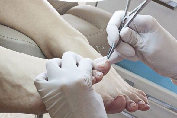 Enlèvement mécanique des ongles des pieds affectés par les champignons