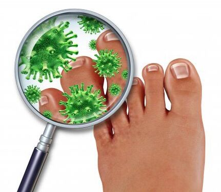 Infection fongique des pieds