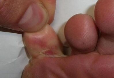 une fissure dans l'orteil est le résultat d'une infection fongique